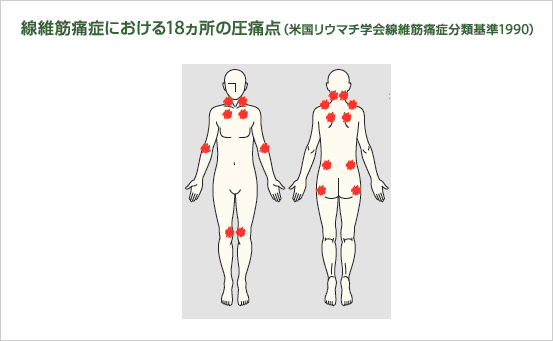 線維筋痛症](fm)｜公益財団法人日本リウマチ財団