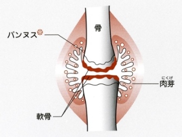 滑膜が絨毛状（“ひだ”のように）に腫れている状態