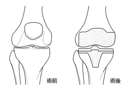右膝関節を前から見たイメージ（灰色の部分が人工関節）