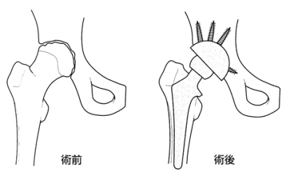 人工股関節全置換術