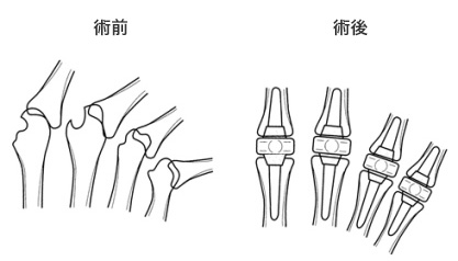 2～5指（人差し指から小指）に対する人工関節置換術