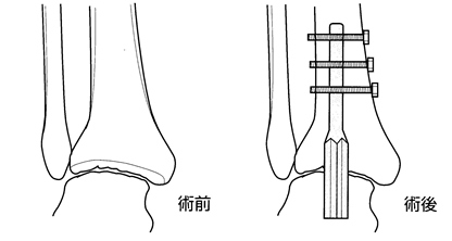 足関節固定術