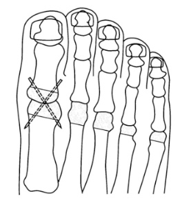 母趾は関節固定術、2-5趾は関節切除術
