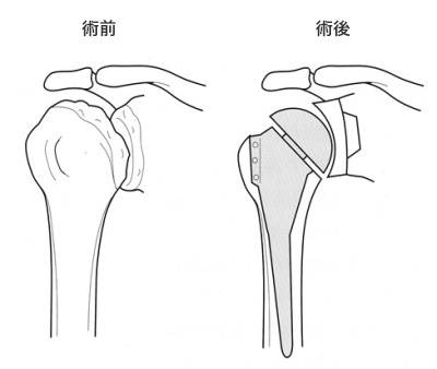 人工肩関節置換術