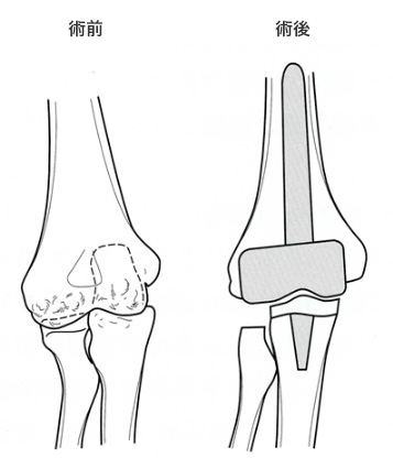 人工肘関節置換術
